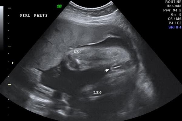1,回答你好怀孕31周做超声检查看胎宝宝的性别是准确的,但是也有看错