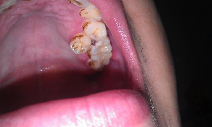 左上两颗大牙旁边长出一颗牙齿,很多年了,不痛