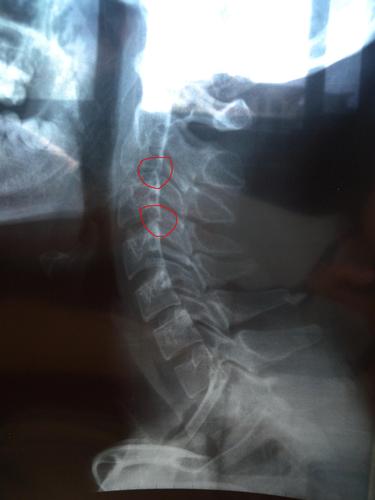 颈椎顺列欠佳,生理曲度存在,诸椎间隙未见狭窄,颈3向后滑移;印象诊断