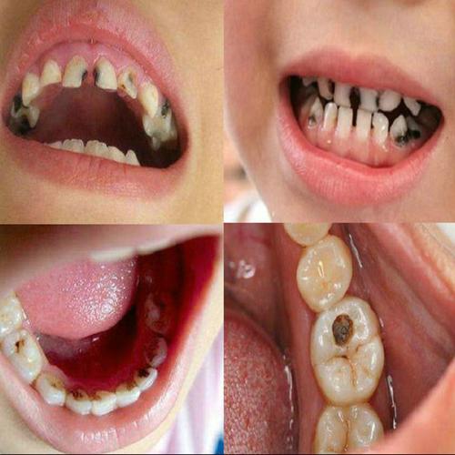 防蛀牙修复牙洞黑斑儿童龋齿虫牙膏孕妇智齿牙疼牙痛特效洗牙渍粉