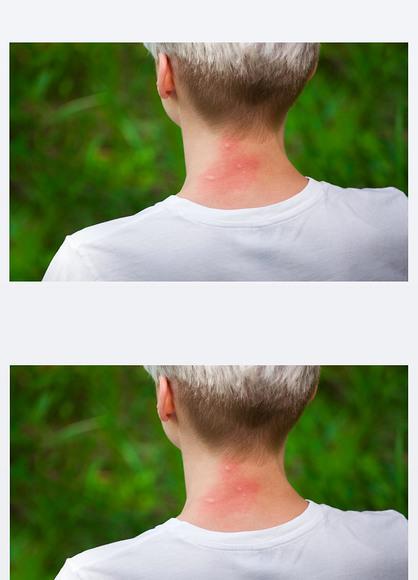 蚊虫叮咬金发女孩坐着他的背转身抓咬红脖子皮肤从蚊