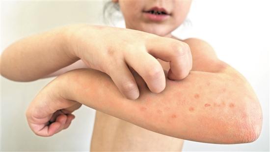 孩子冬季"湿疹"频发?可能是特应性皮炎