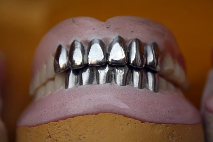 金属的牙齿,牙科,义齿