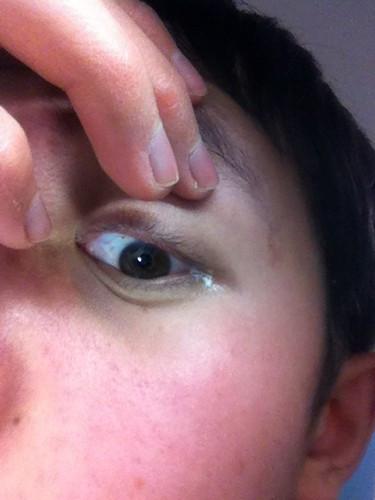 眼睛里有白色粘稠状物质是结膜炎吗