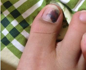 大脚趾的指甲里面一半发紫有1个月了不知道是什么情况 答题抽 