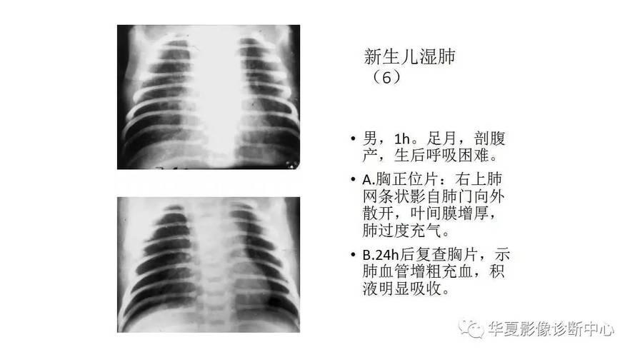 影像基础新生儿肺部常见疾病的x线诊断下