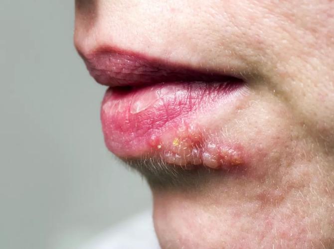 口唇疱疹常见的样子