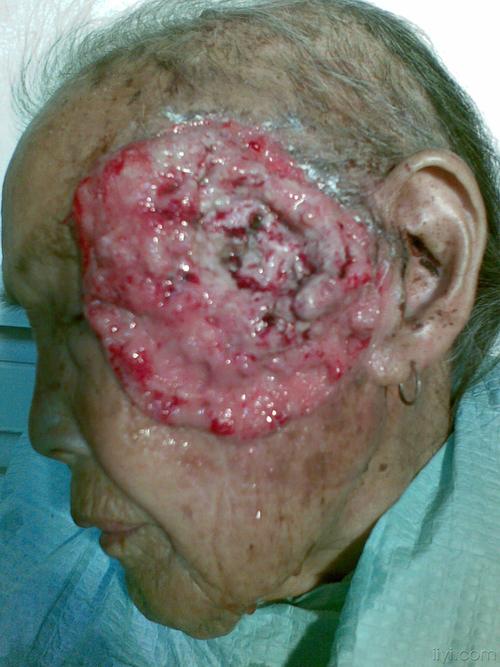 【病例讨论 2009-6】左面部皮肤癌合并蝇蛆感染