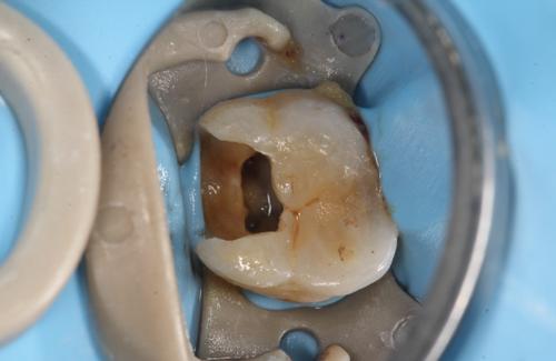 怎样区分可逆性牙髓炎和不可逆性牙髓炎?
