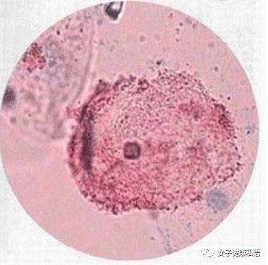 妇科检查显示细菌性阴道炎怎么办关于细菌性阴道炎你一定要知道的事